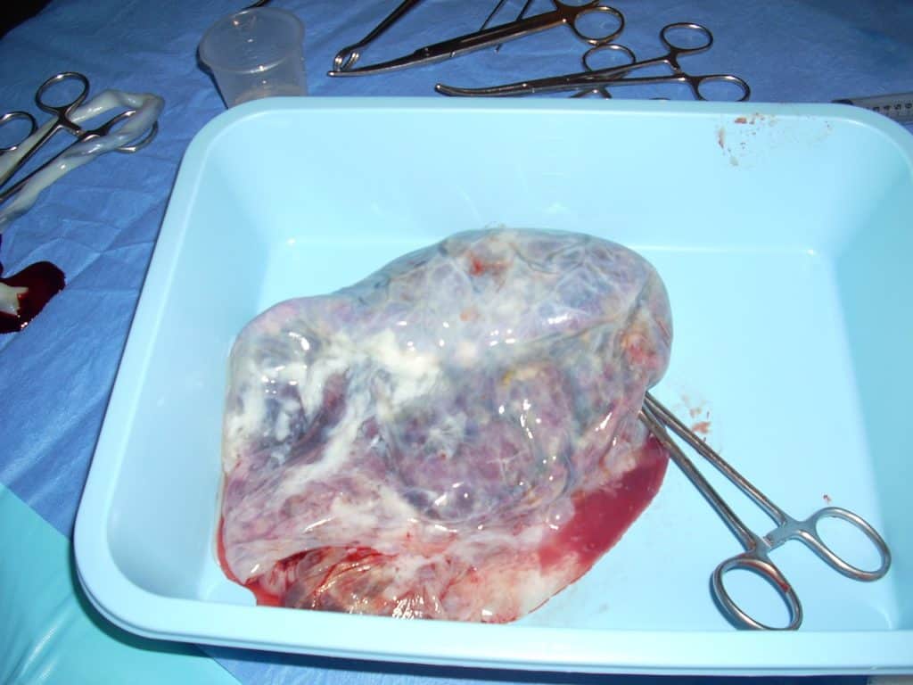 דם טבורי
